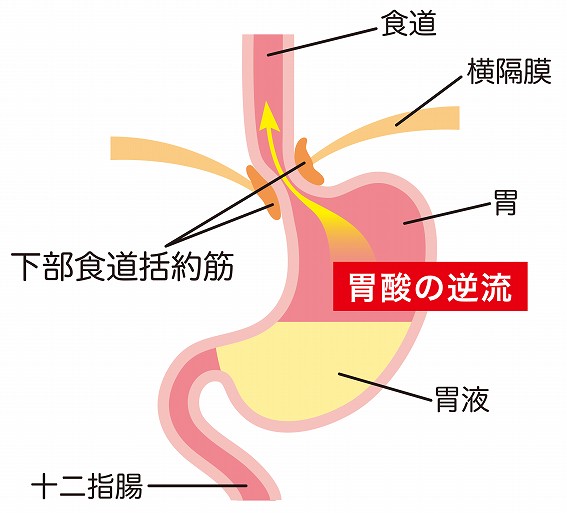 逆流性食道炎イメージ